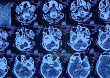 মাথার একপাশ দিয়ে ঢুকে অন্যপাশ দিয়ে বের হয়ে গেছে গুলি: হাদির চিকিৎসক