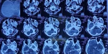 মাথার একপাশ দিয়ে ঢুকে অন্যপাশ দিয়ে বের হয়ে গেছে গুলি: হাদির চিকিৎসক