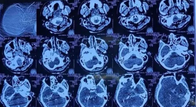 মাথার একপাশ দিয়ে ঢুকে অন্যপাশ দিয়ে বের হয়ে গেছে গুলি: হাদির চিকিৎসক